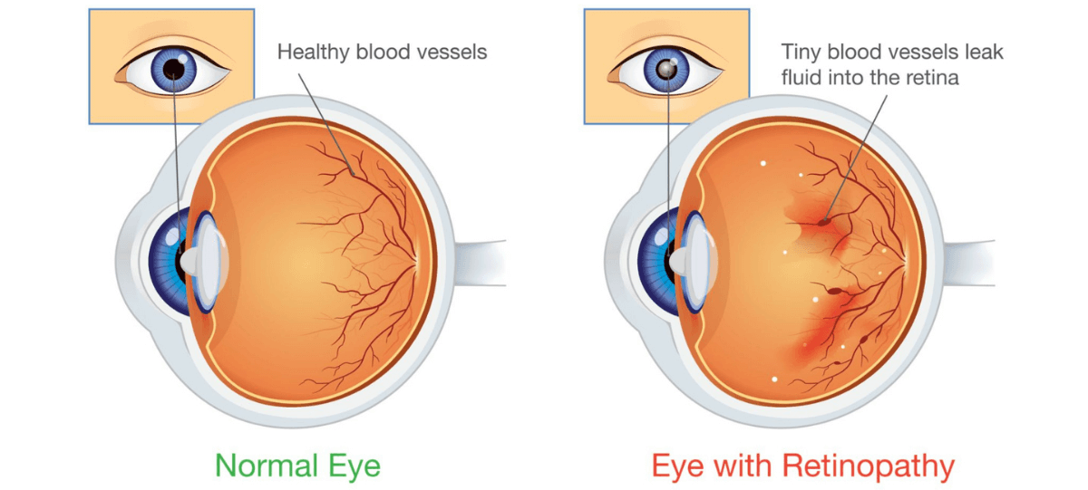 Diabetic Retinopathy – Causes, Symptoms, Risks & Prevention - Vision ...